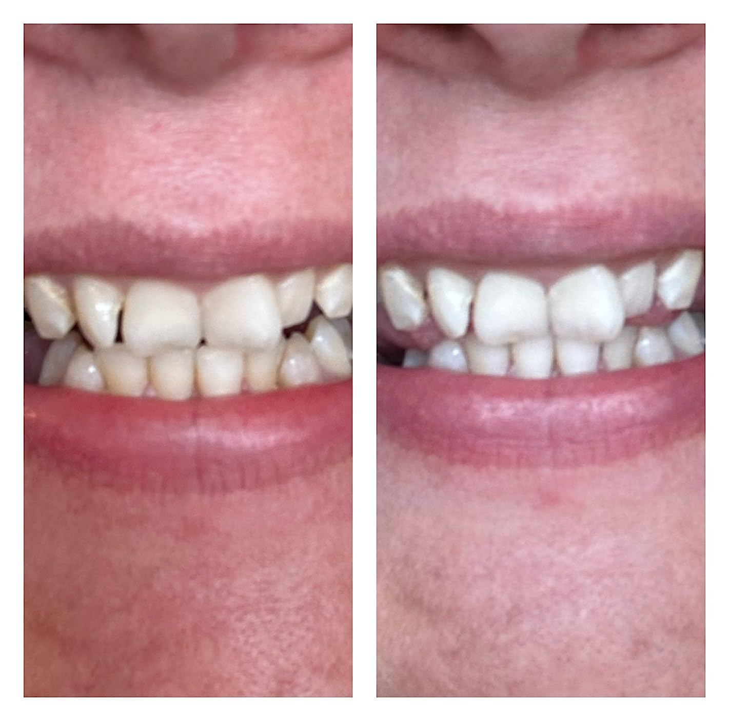 Hismile v34 Colour Corrector Serum, Teeth Brightening img 4